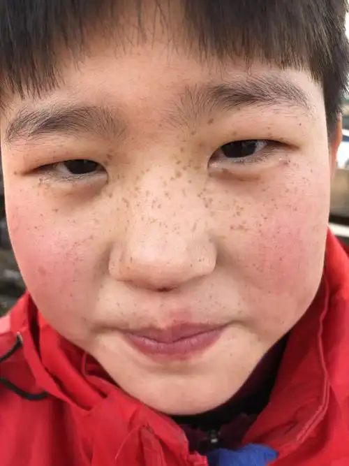 遗传的斑小时候就有,可以激光去除吗,有没有跟我一样用激光去斑的