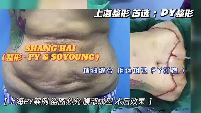 减肥##腹壁整形##腹壁成型术# ♀:腹壁成型 对比 总所周知腹壁成形