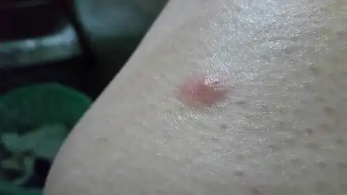 长在大腿内侧,不是很痒.