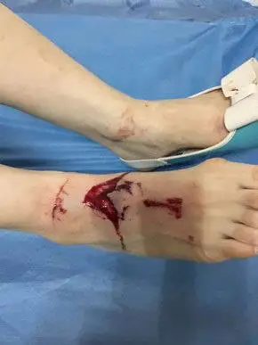 洗手台掉落砸断女子脚部神经