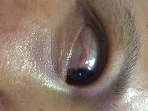 眼睛里长了个小疙瘩.2.今天晚上才发现有这种情况.3.以前没有出现过