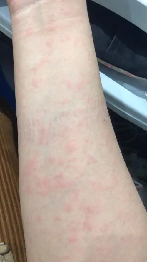 胎停查出抗核抗体阳性1:320颗粒型现在吃纷乐一个月全身过敏怎么办?