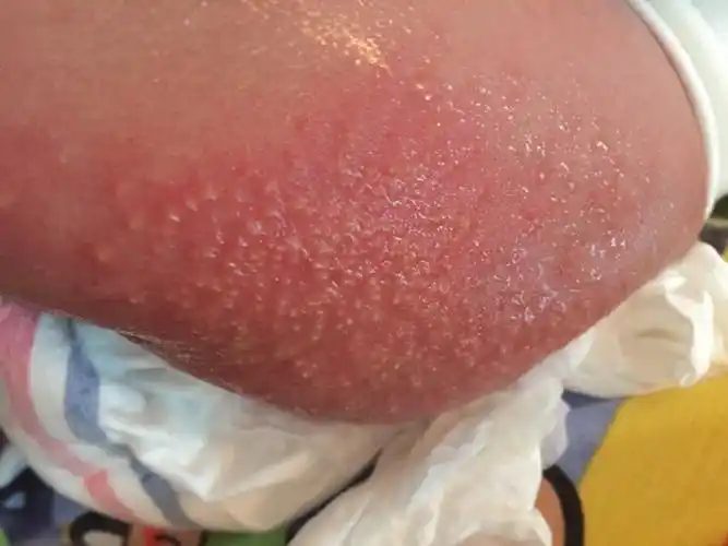 新生儿左侧屁股感染湿疹怎么办?急疯了,宝宝好可怜