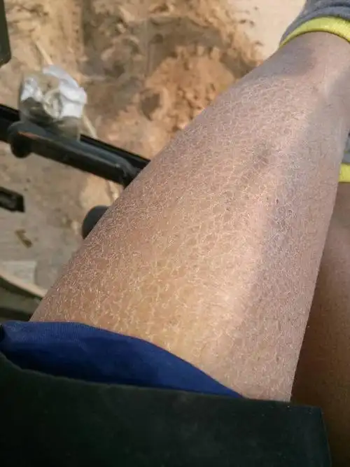 晚上洗完澡第二天腿上的皮肤为什么会这样?怎么才能光滑一点