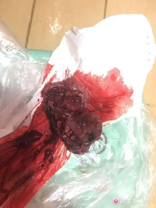 请问有经验的亲,可以帮我看看,我排出的是孕囊吗?有图