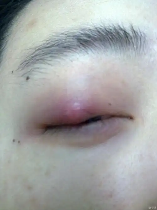 霰粒肿求证?该如何处理?