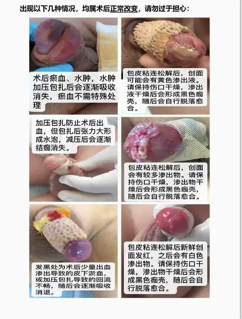 碰到一些影响到小孩健康的包皮疾病,如反复感染,包茎,可以选择手术