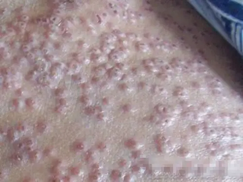 孕妇疥疮初期腹部皮肤症状图片