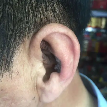 请问耳朵这样是得什么病了 求解答谢谢