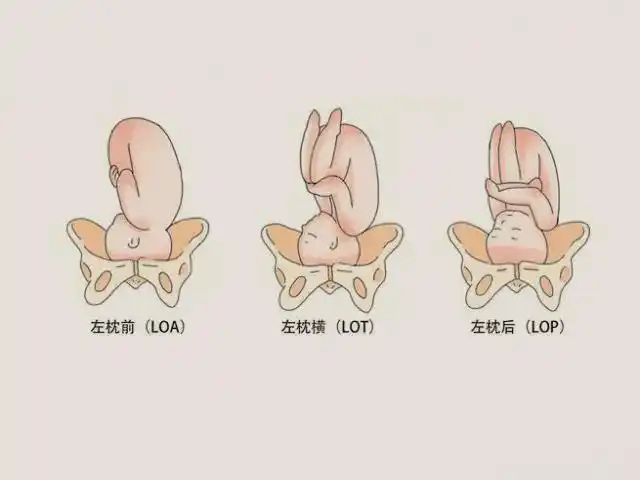 孕32周loa胎位在肚子里的样子是怎样的