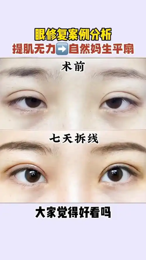 眼修复案例:提肌无力修复成自然妈生平扇