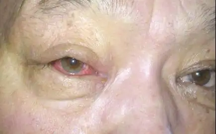 上火了,眼睛充血.怎么办