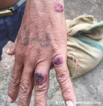 皮肤炭疽病的症状图片,红斑发展成水疱坏死形成溃疡黑痂