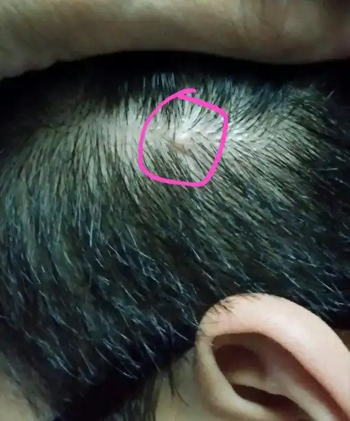 头上长了个痘痘大小的东西,五六年了,不疼不痒,也一直都这么大.