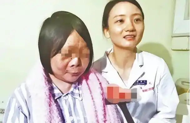 22岁女孩长了一张"马脸",14年不出门,两次手术后大变样