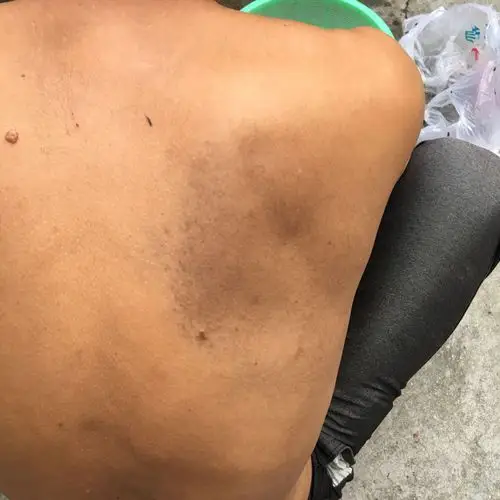 爸爸今年49岁了,背后长了一块黑色的斑一样的,说