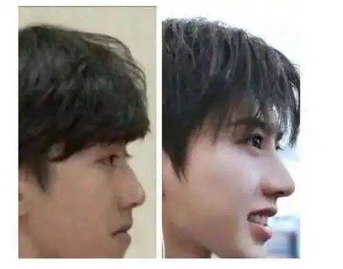高人气蔡徐坤整容前后对比照曝光