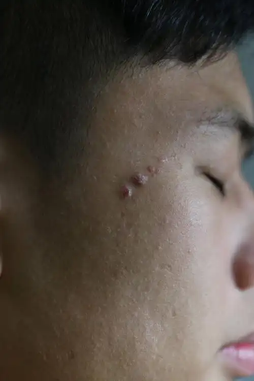 我的脸上的疣一样的东西!