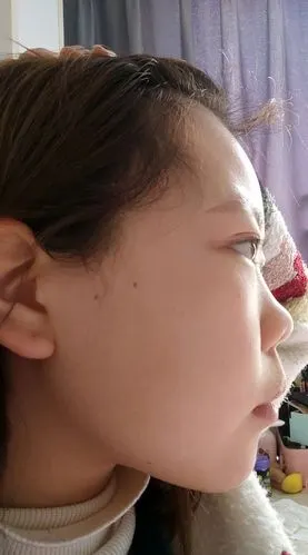 无鼻梁塌鼻子朝天鼻还有救吗?