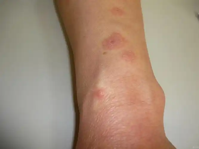 典型病例多形红斑