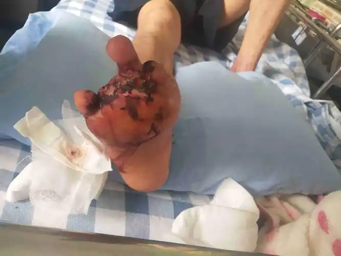 右脚因上班维修机子时开关失灵被机器挤压导致脚趾根骨头碎完血管坏了