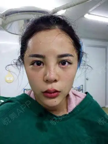 做的是开眼角加什么眼睑下至的,因为之前也有做过双眼.