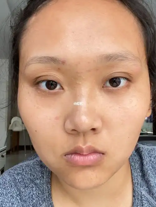 记录一下皮肤状态