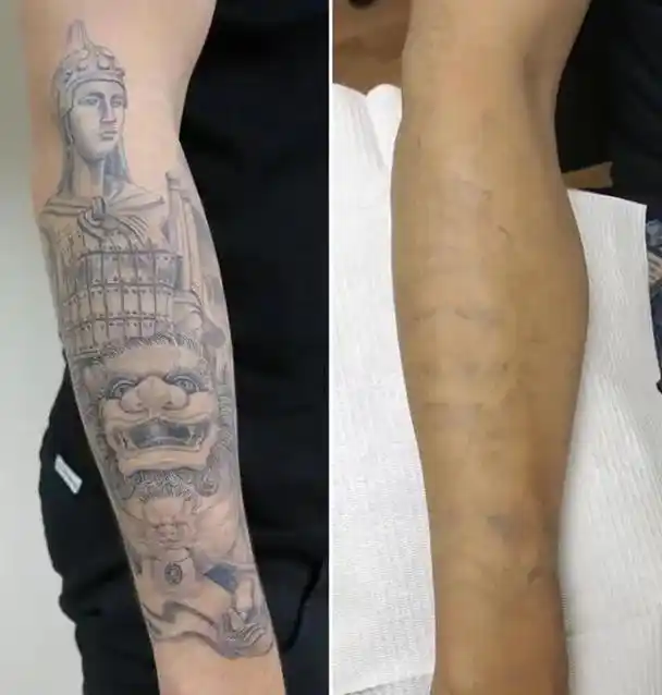 洗纹身真实案例一次比一次淡,且恢复后皮肤平整继续清洗会越 - 抖音