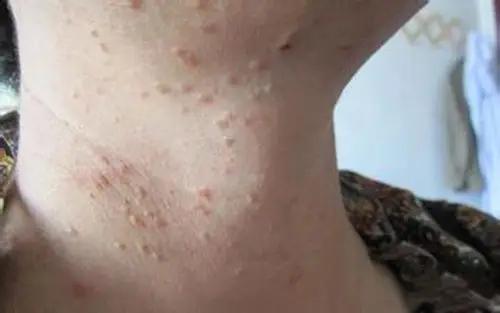 脖子处待治疗扁平疣图片