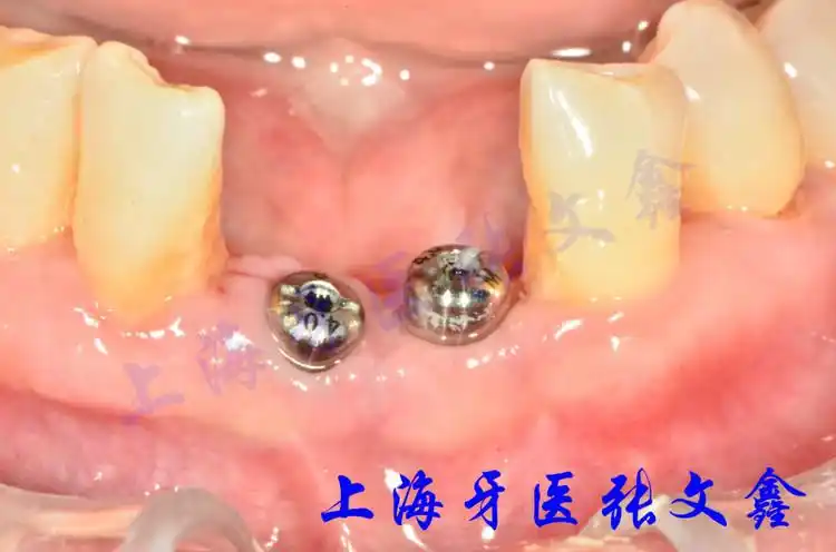 下面两张照片是取出愈合基台后的照片,可以看出围绕种植体周围的
