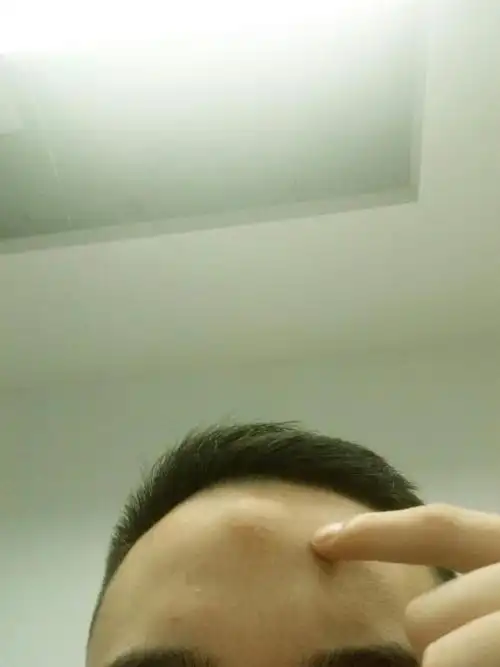 我头上这个包 不疼不痒 有半年了 也消不了 我想问下这是什么病 需要