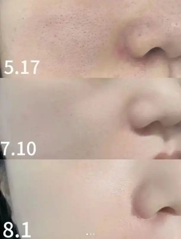 10个信号提醒你该做"水光" 1,皮肤经常很紧绷 2,皮肤