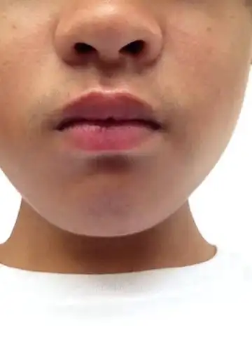 我下巴长了一根长达1cm的胡子.好不好才15周岁.