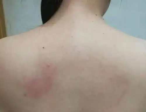 艾滋病后背疙瘩照片以及疙瘩特点症状