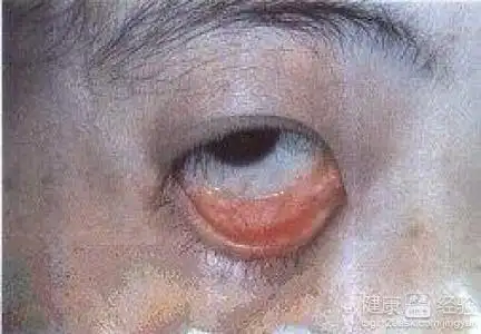 高血糖引起上眼皮里面溃疡怎么办