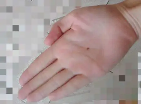 寻一枚左手掌心有痣的男人!有图