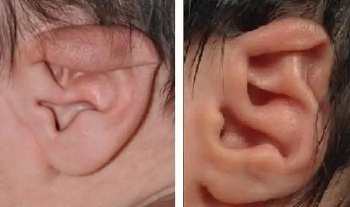 常见先天性耳廓畸形