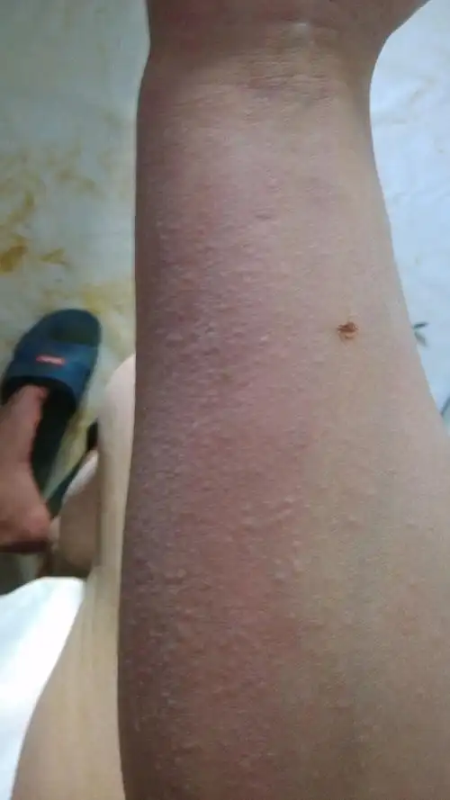 身上一热就痒 一挠起一层小疙瘩 怎么回事啊 我还患有牛皮癣 有关系吗