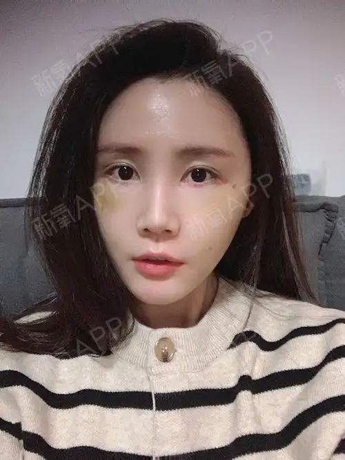 自体脂肪全面部填充恢复的第10天