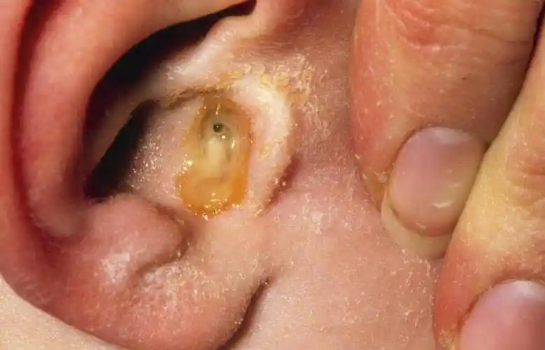 这可能与湿疹,银屑病,接触性皮炎等皮肤疾病有关.