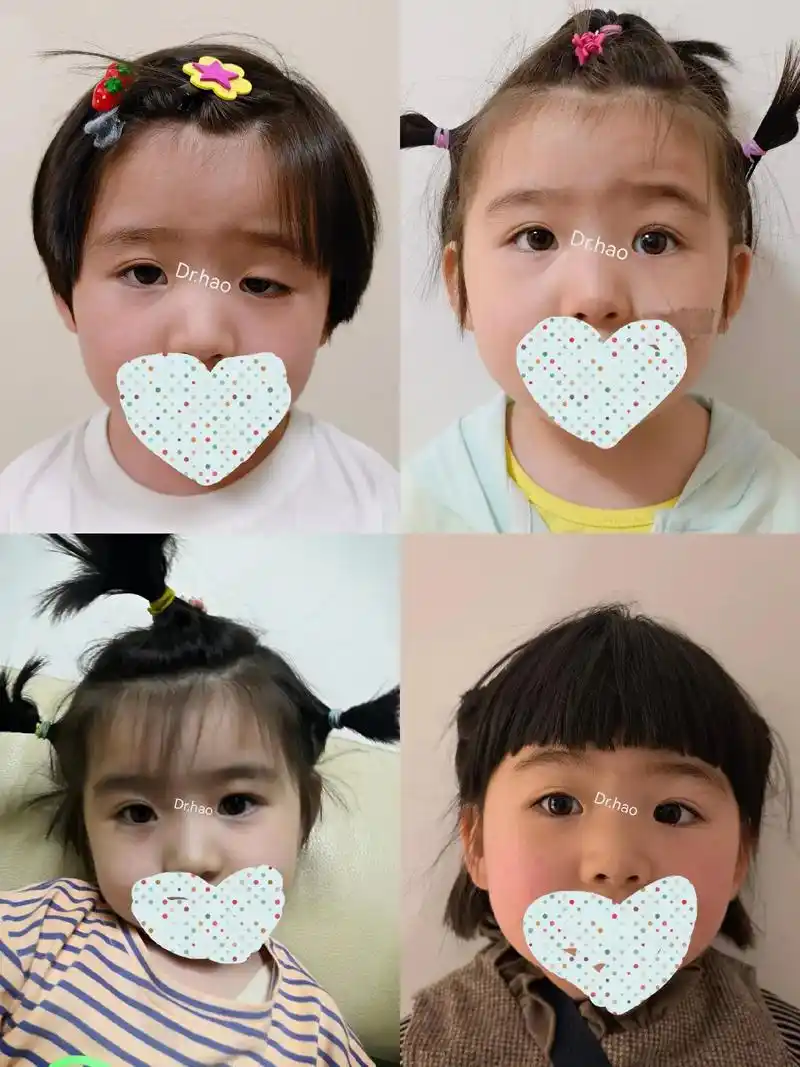 上睑下垂是一种儿童或成人常见的眼睑位置异常,其影响 - 抖音