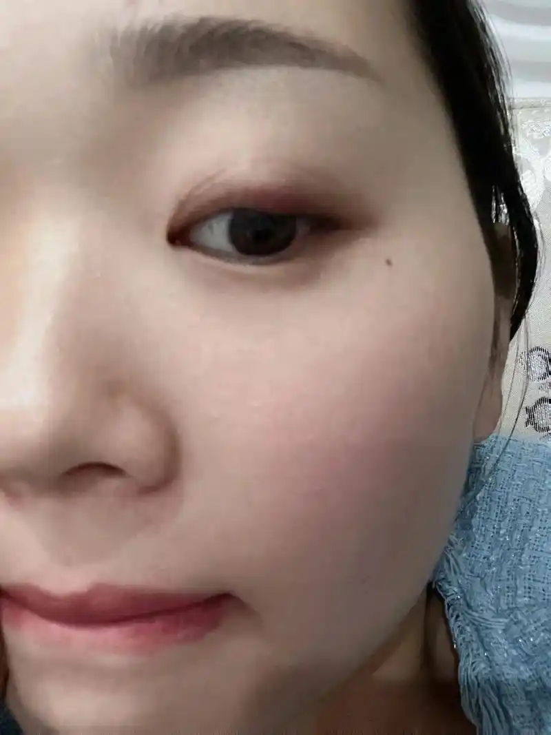 眼皮里面长了一个硬疙瘩,长了好几年了一直也没管