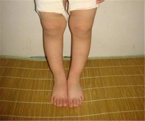 婴儿佝偻病的症状图片方颅宝宝佝偻病宝宝佝偻病的症状宝宝半岁佝偻病