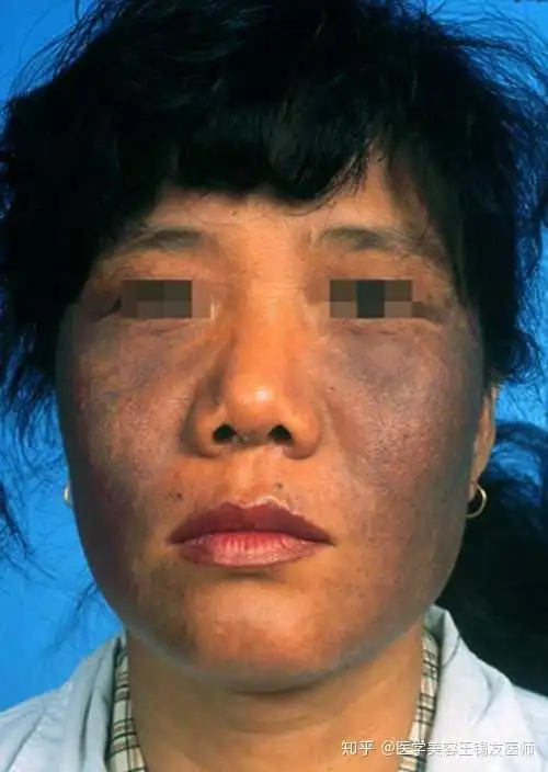 皮肤变黑也是一种病