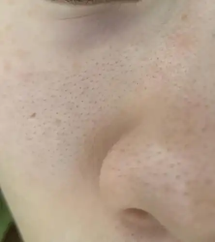 慎入脸上的毛孔会长黑色的毛毛并且越来越多该怎么办