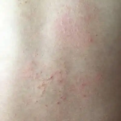 问答 怀孕期 推荐回答                      我也长有,不过在肚皮上