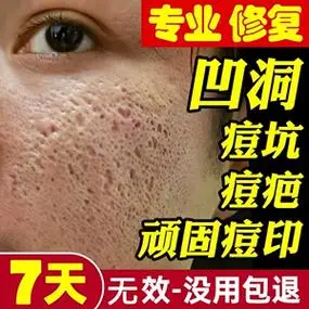 去痘印痘坑痘疤痕修护祛痘膏淡化消印凹洞填充再生收缩毛孔男士女