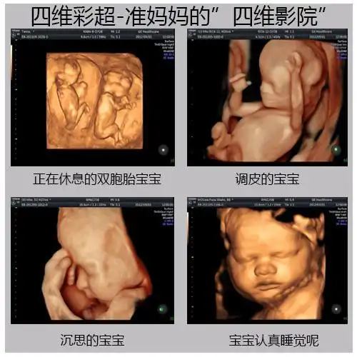 四维彩超这些细节透露了胎儿性别这篇文章在各个宝妈群里疯传