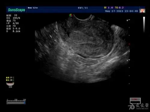 宫颈粘连,宫腔积血?