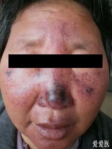 植物日光性皮炎图